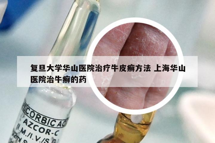复旦大学华山医院治疗牛皮癣方法 上海华山医院治牛癣的药