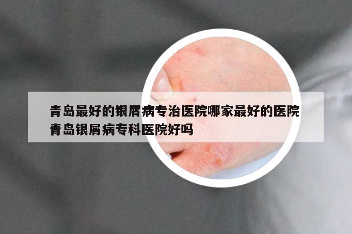 青岛最好的银屑病专治医院哪家最好的医院 青岛银屑病专科医院好吗