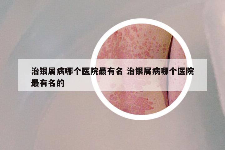 治银屑病哪个医院最有名 治银屑病哪个医院最有名的