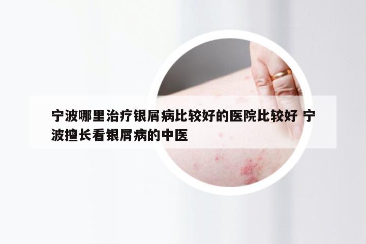 宁波哪里治疗银屑病比较好的医院比较好 宁波擅长看银屑病的中医