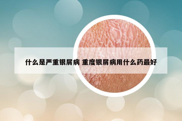 什么是严重银屑病 重度银屑病用什么药最好