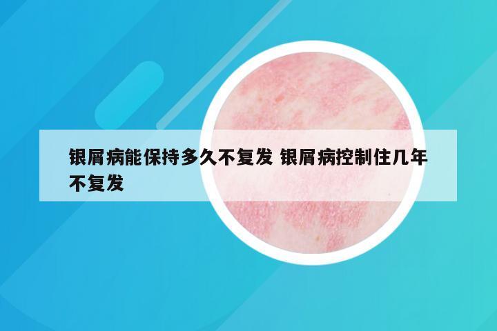 银屑病能保持多久不复发 银屑病控制住几年不复发