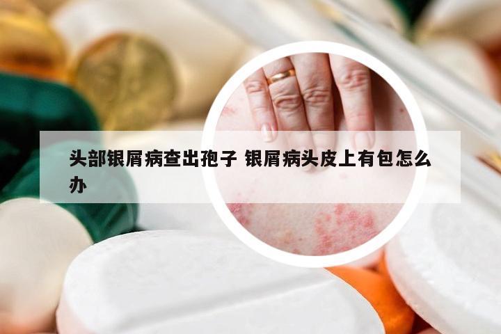 头部银屑病查出孢子 银屑病头皮上有包怎么办