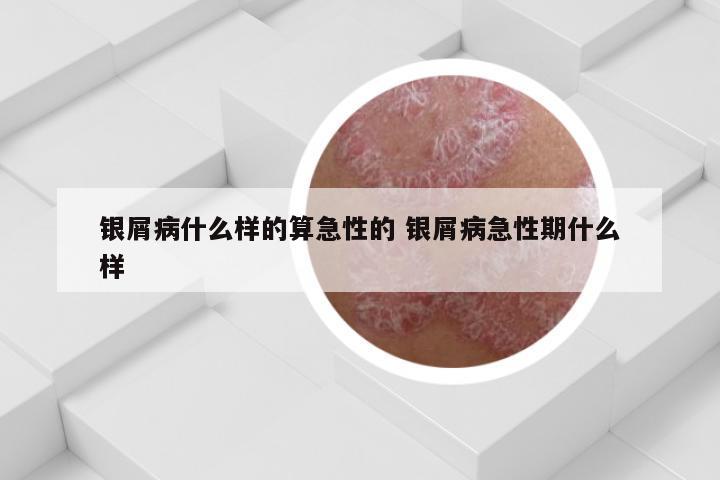 银屑病什么样的算急性的 银屑病急性期什么样