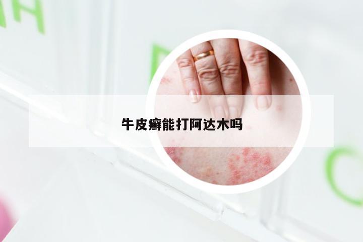 牛皮癣能打阿达木吗