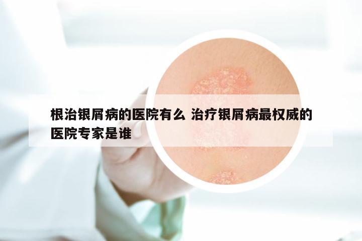 根治银屑病的医院有么 治疗银屑病最权威的医院专家是谁