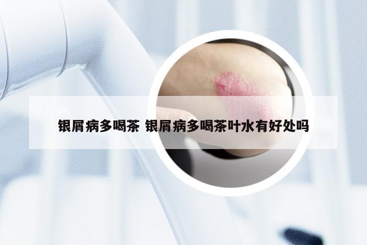 银屑病多喝茶 银屑病多喝茶叶水有好处吗