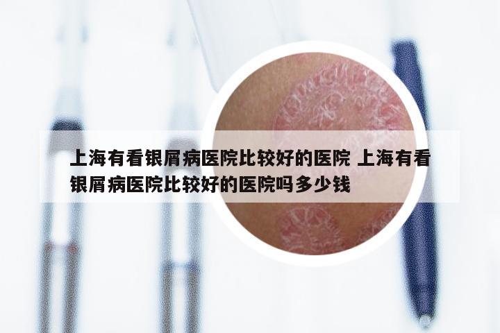 上海有看银屑病医院比较好的医院 上海有看银屑病医院比较好的医院吗多少钱
