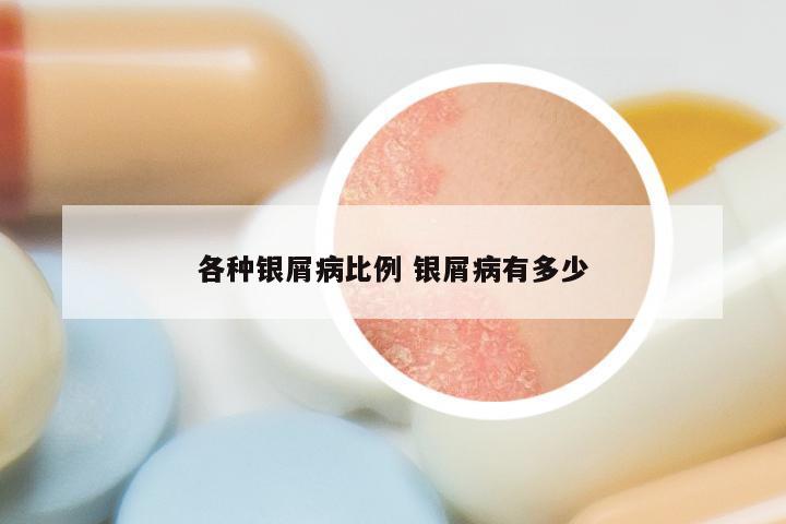 各种银屑病比例 银屑病有多少