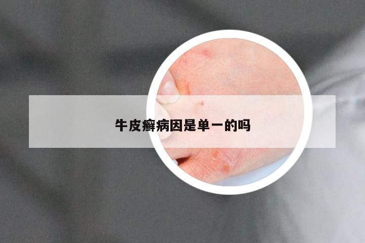 牛皮癣病因是单一的吗