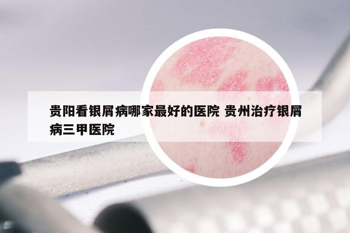贵阳看银屑病哪家最好的医院 贵州治疗银屑病三甲医院
