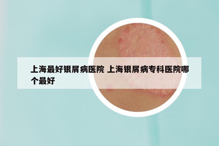 上海最好银屑病医院 上海银屑病专科医院哪个最好