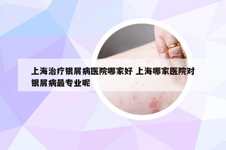 上海治疗银屑病医院哪家好 上海哪家医院对银屑病最专业呢