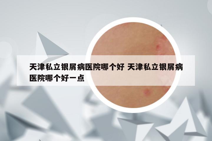 天津私立银屑病医院哪个好 天津私立银屑病医院哪个好一点