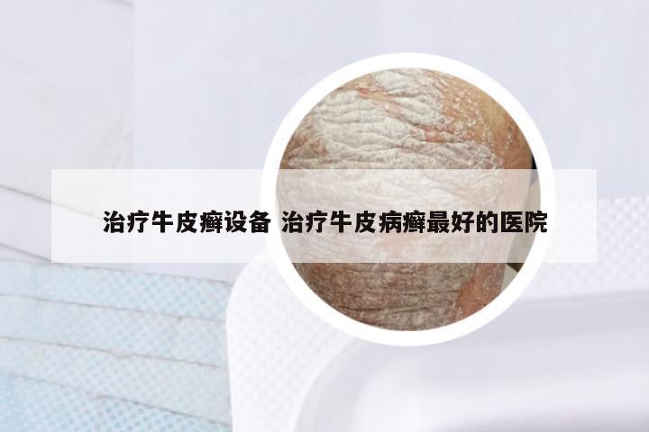 治疗牛皮癣设备 治疗牛皮病癣最好的医院