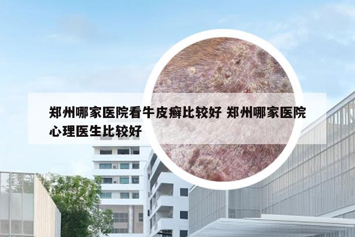 郑州哪家医院看牛皮癣比较好 郑州哪家医院心理医生比较好