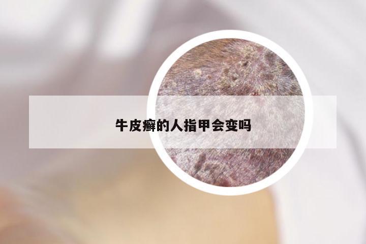 牛皮癣的人指甲会变吗