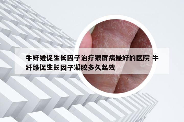 牛纤维促生长因子治疗银屑病最好的医院 牛纤维促生长因子凝胶多久起效