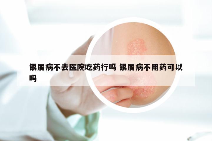 银屑病不去医院吃药行吗 银屑病不用药可以吗