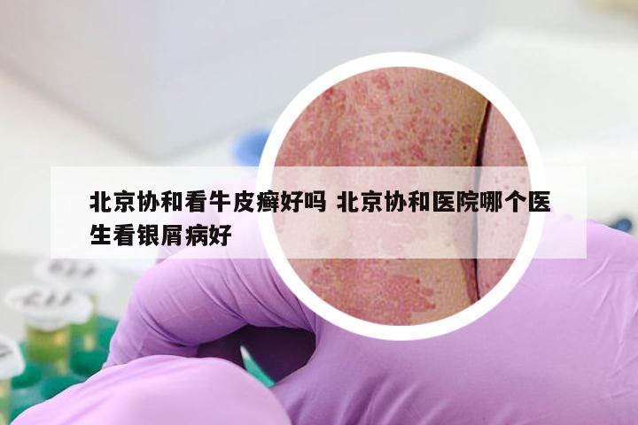 北京协和看牛皮癣好吗 北京协和医院哪个医生看银屑病好