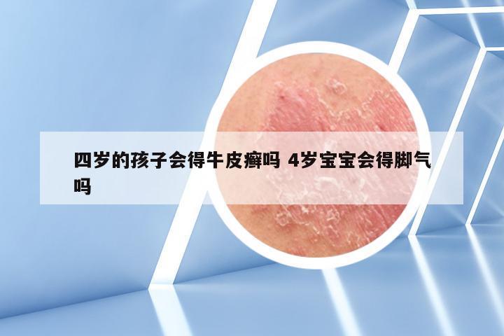 四岁的孩子会得牛皮癣吗 4岁宝宝会得脚气吗