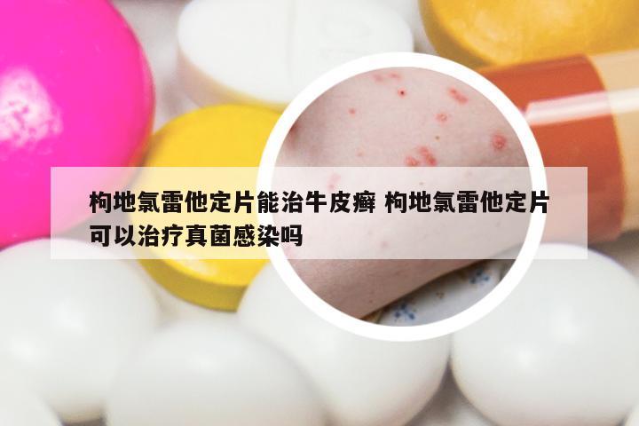 枸地氯雷他定片能治牛皮癣 枸地氯雷他定片可以治疗真菌感染吗