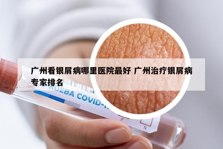 广州看银屑病哪里医院最好 广州治疗银屑病专家排名