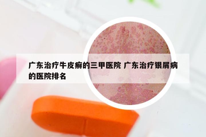 广东治疗牛皮癣的三甲医院 广东治疗银屑病的医院排名