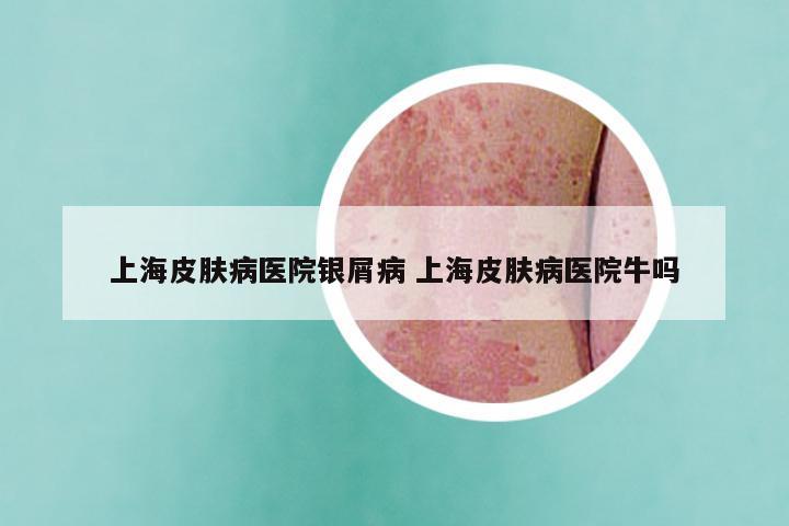 上海皮肤病医院银屑病 上海皮肤病医院牛吗