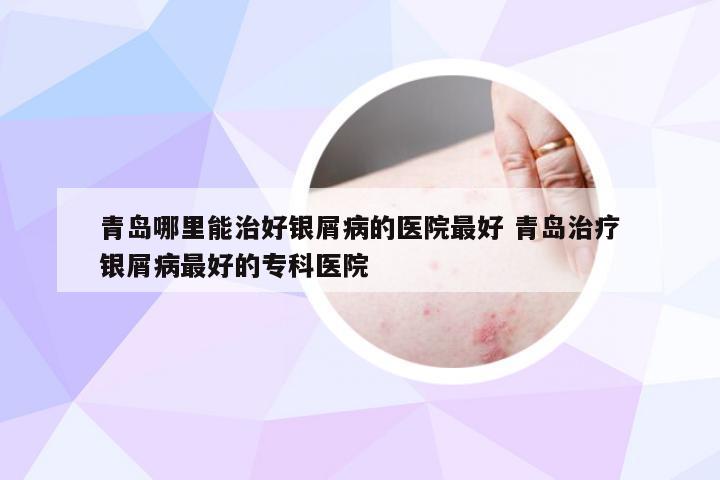 青岛哪里能治好银屑病的医院最好 青岛治疗银屑病最好的专科医院