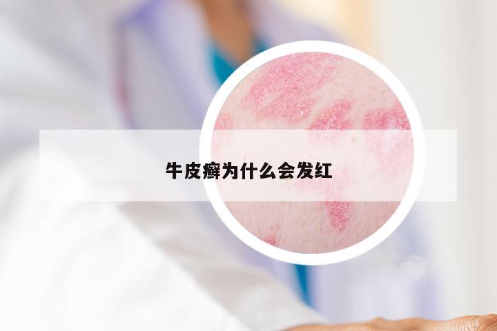 牛皮癣为什么会发红
