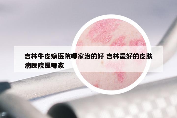 吉林牛皮癣医院哪家治的好 吉林最好的皮肤病医院是哪家