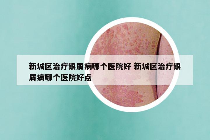 新城区治疗银屑病哪个医院好 新城区治疗银屑病哪个医院好点