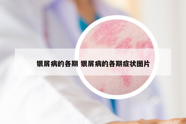 银屑病的各期 银屑病的各期症状图片