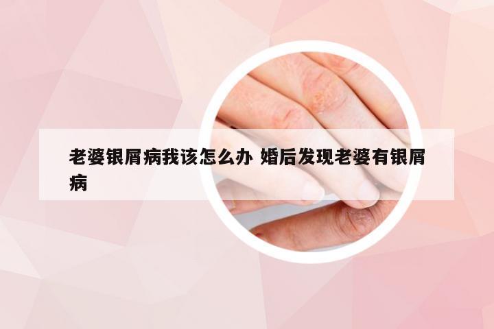 老婆银屑病我该怎么办 婚后发现老婆有银屑病