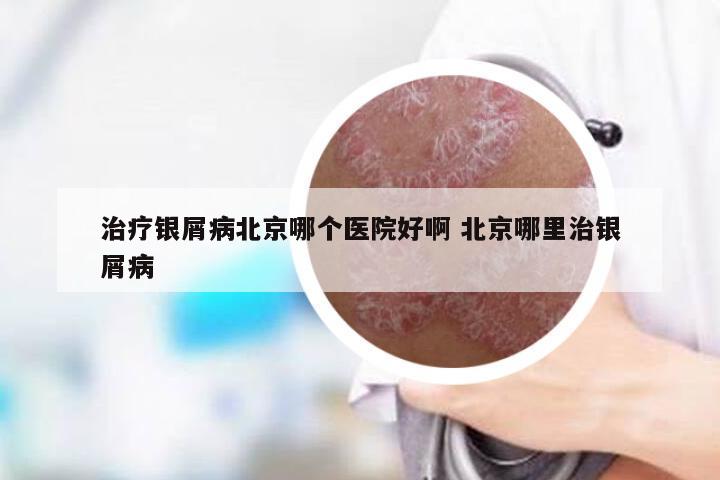 治疗银屑病北京哪个医院好啊 北京哪里治银屑病