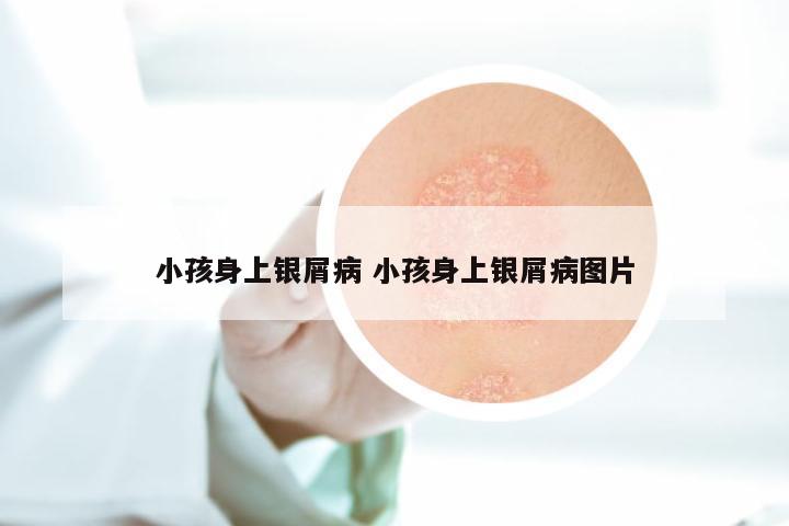 小孩身上银屑病 小孩身上银屑病图片