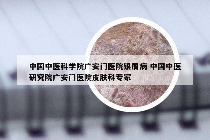 中国中医科学院广安门医院银屑病 中国中医研究院广安门医院皮肤科专家