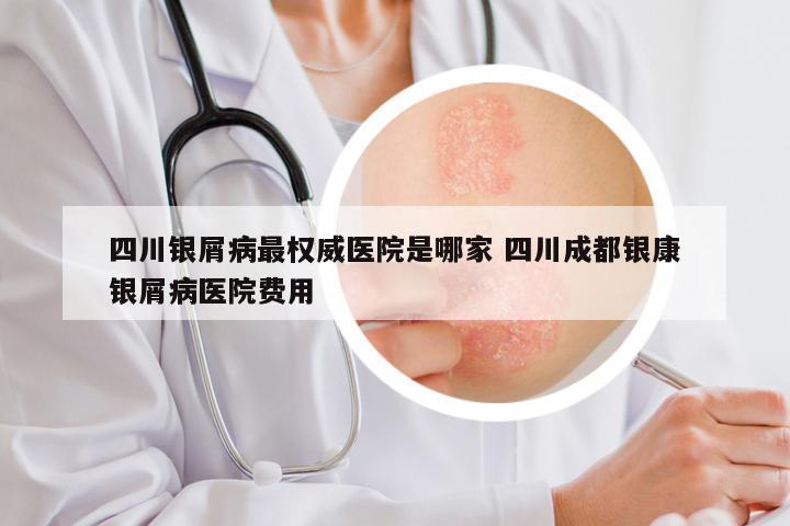 四川银屑病最权威医院是哪家 四川成都银康银屑病医院费用