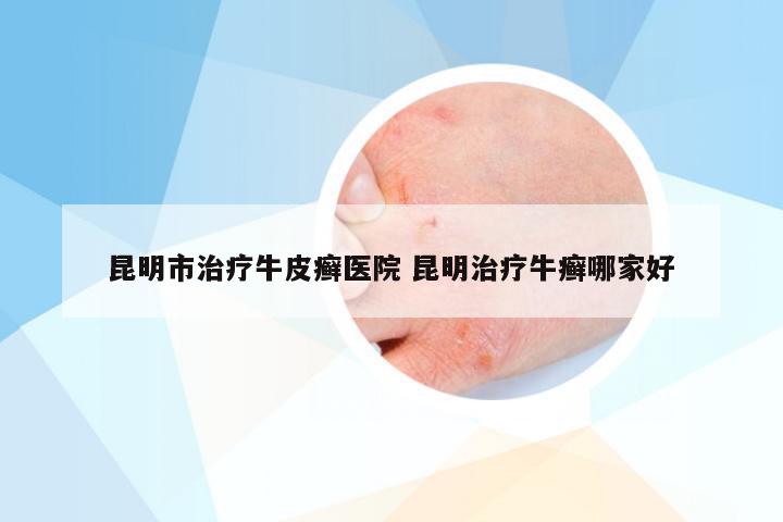 昆明市治疗牛皮癣医院 昆明治疗牛癣哪家好