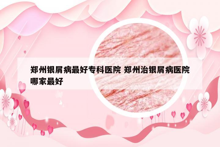 郑州银屑病最好专科医院 郑州治银屑病医院哪家最好
