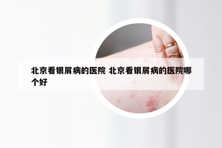 北京看银屑病的医院 北京看银屑病的医院哪个好
