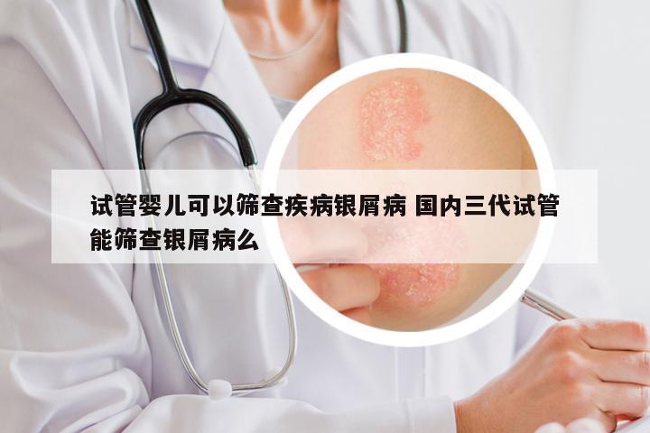 试管婴儿可以筛查疾病银屑病 国内三代试管能筛查银屑病么