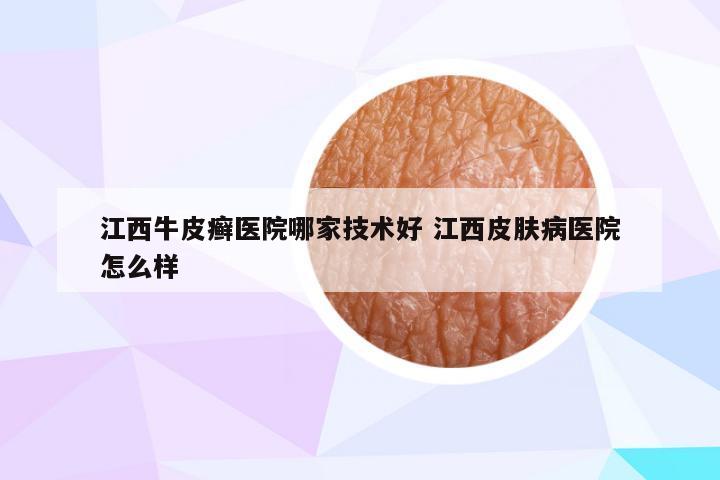 江西牛皮癣医院哪家技术好 江西皮肤病医院怎么样