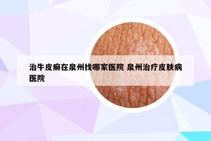 治牛皮癣在泉州找哪家医院 泉州治疗皮肤病医院