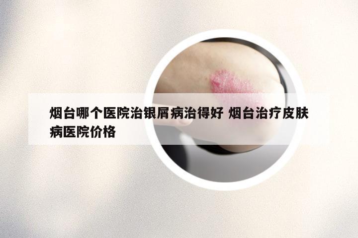 烟台哪个医院治银屑病治得好 烟台治疗皮肤病医院价格