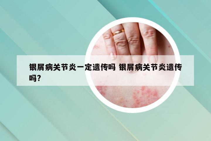 银屑病关节炎一定遗传吗 银屑病关节炎遗传吗?