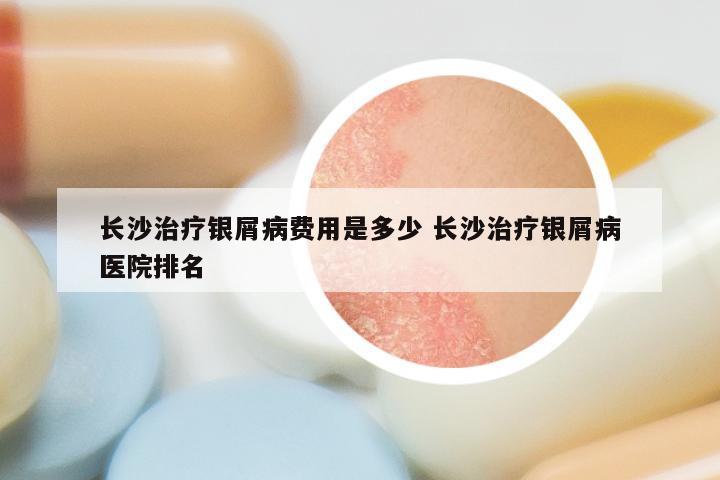 长沙治疗银屑病费用是多少 长沙治疗银屑病医院排名