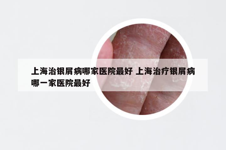 上海治银屑病哪家医院最好 上海治疗银屑病哪一家医院最好