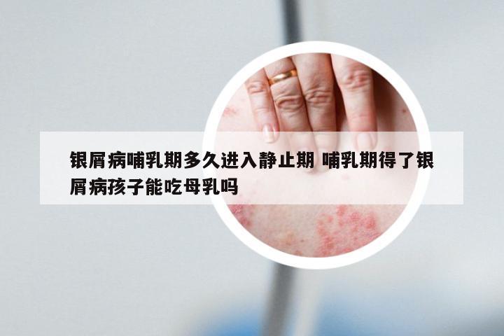 银屑病哺乳期多久进入静止期 哺乳期得了银屑病孩子能吃母乳吗
